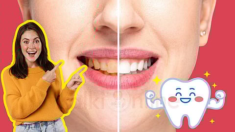 Yellow stains on teeth