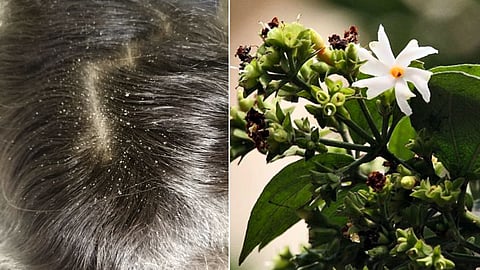 Natural ways to get rid of dandruff!