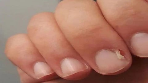 Hangnails