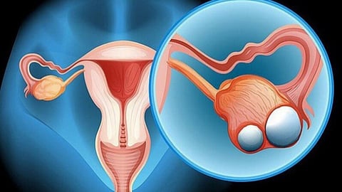 Ovarian Cyst