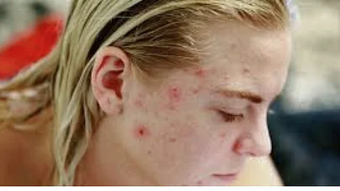 The cause of acne...