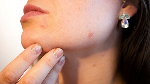 Say Ta ta to Scars in a Healthy Way!