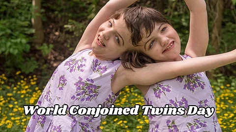 Conjoined Twins