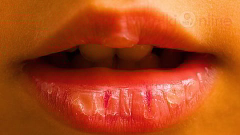 sunburnt cracked lips