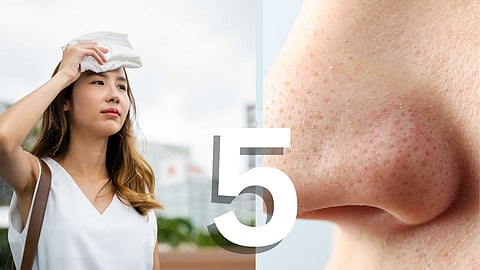 5 home remedies to get rid of dark spots on face!