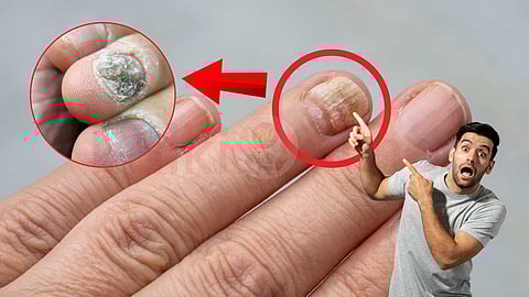 Nail fungus