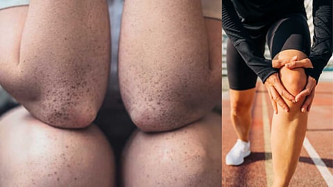 Simple Remedies to clear Blackheads