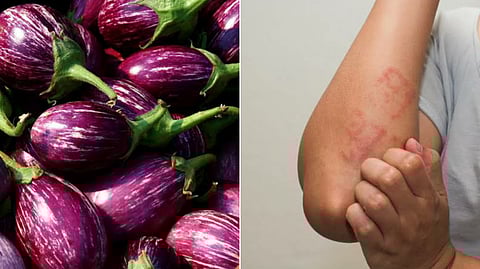 Brinjal Allergy