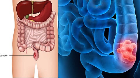 Modern medicine for colon cancer!