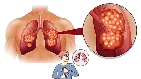 Popcorn Lung Disease
