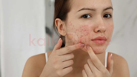 Natural treatments for pimples!