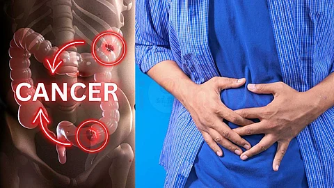 Colon and rectal cancer