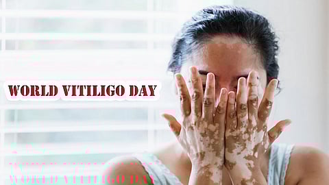World vitiligo Day