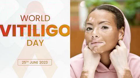 World Vitiligo Day)