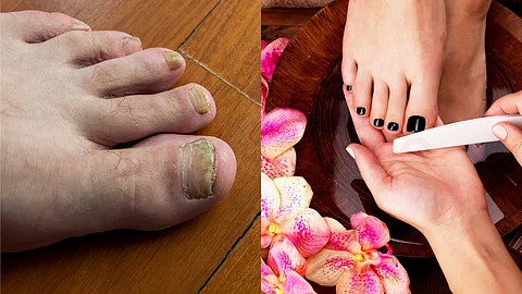 Nail care