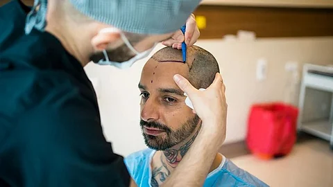Hair transplant surgery