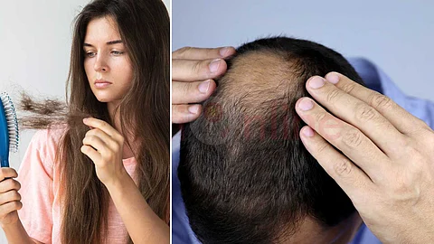 Hair loss is...