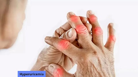 hyperuricemia in fingers and joints