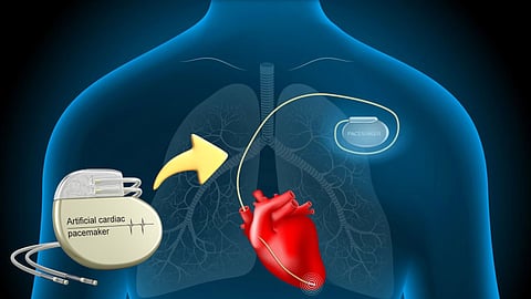 Cardiac pacemaker