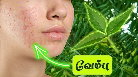 Neem for acne