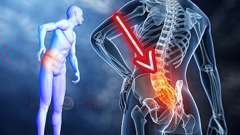 sciatica