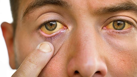 Jaundice symptoms and remedies
