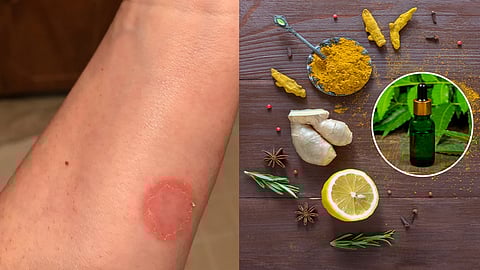 ringworm treatment home remedy
