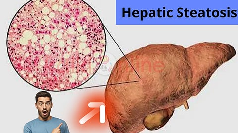 Hepatic Steatosis