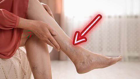 Varicose Veins