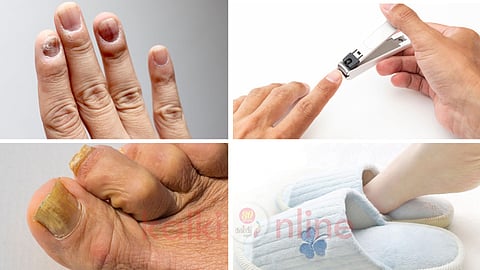 Onychomycosis home remedies