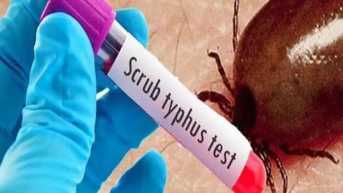 scrub typhus