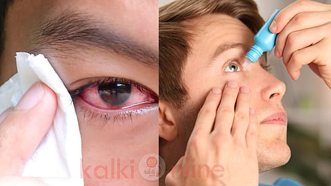 Madras eye problem and remedies