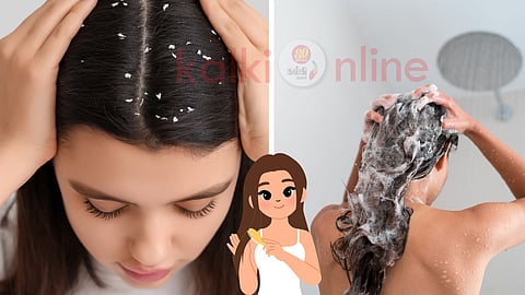 Dandruff problem and solutions