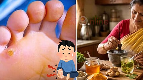Foot corn and home remedies