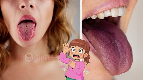 Splitted tongue and purple tongue