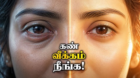 Eyebags | கண் வீக்கம்