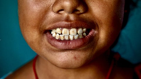 Nearly half of the schoolchildren examined as part of a new study in Baliapur block of Dhanbad exhibited signs of dental and skeletal fluorosis.