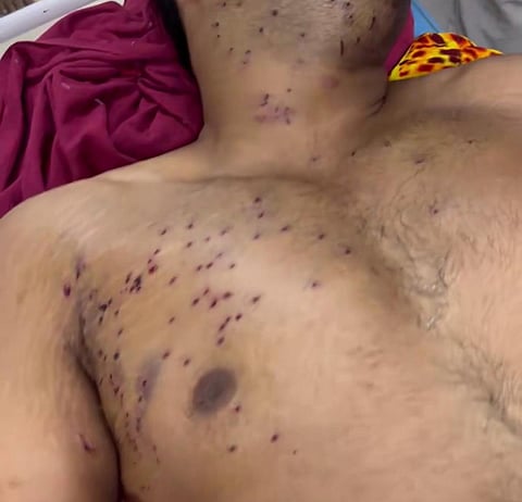 A protester allegedly injured by pellet gun in police action at Palika Bazaar in Connaught Place by a Rapid Action Force (RAF) jawan in uniform in New Delhi.
