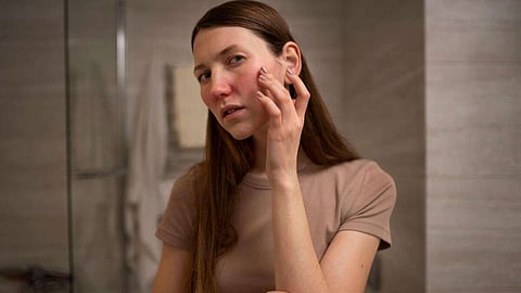 لاحظ الأطباء ارتفاعاً في عدد المرضى الذين يشكون من ظهور البثور وجفاف الجلد المفرط