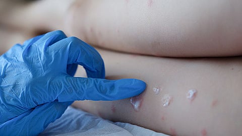 UP health officials issued guidelines against Monkeypox outbreak in Lucknow