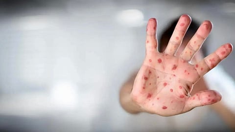 After COVID-19, measles in Mumbai causes distress, total cases reach 475