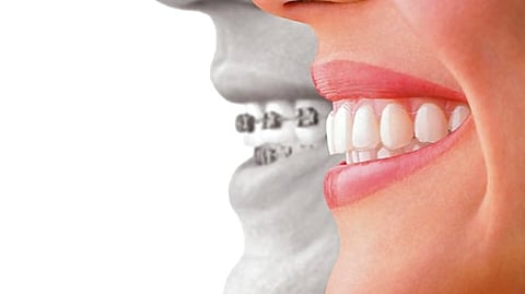Move over conventional braces, it's time to try the hassle-free aligners by REALTOOTH in Lucknow