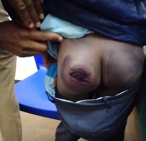 Wounds inflicted by teacher on 9 year old pupil