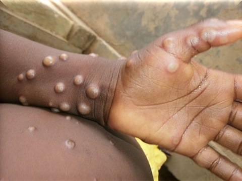 Monkeypox