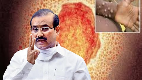 MonkeyPox and Rajesh tope