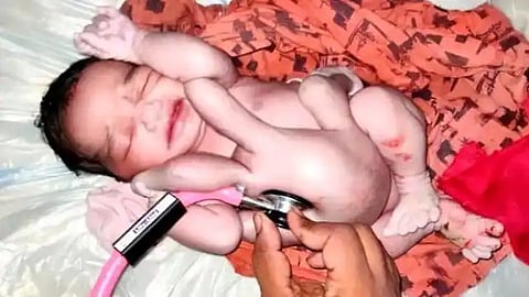 मुल जन्माला आल्याचा आनंद झाला, पण 4 हात अन् 4 पाय पाहून चक्रावले आई-वडील