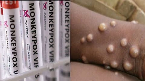 Monkeypox in India | WHO