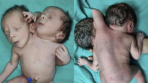 Dycephalic Paraphagus