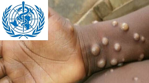 Monkeypox जागतिक आरोग्य आणीबाणी म्हणून जाहीर; WHO ची घोषणा