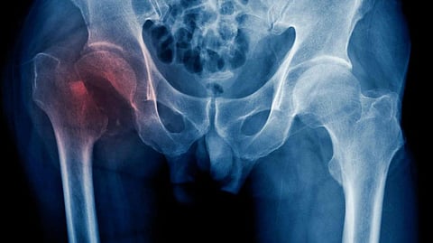 Hip Fracture | vegetarian women